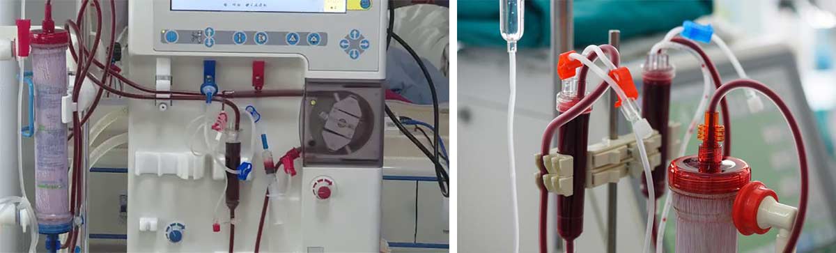 Exploring the Role of AI in Advanced Smart Dialysis Machine Solutions ...