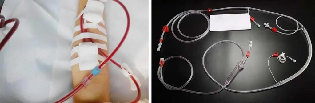 blood-transfusion-and-dialysis