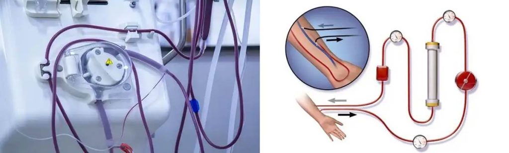 can-dialysis-remove-fluid-from-lungs