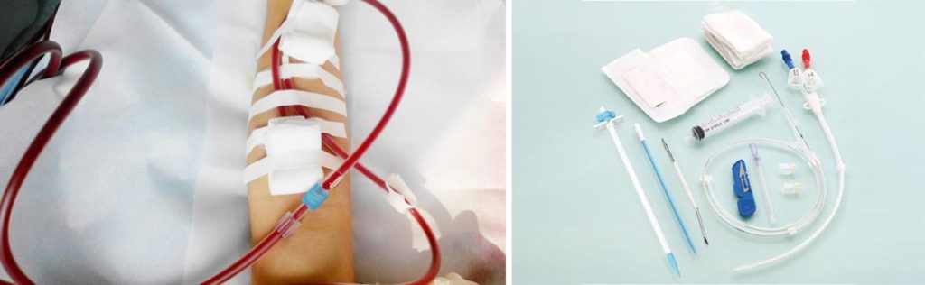 can-you-have-dialysis-2-days-in-a-row