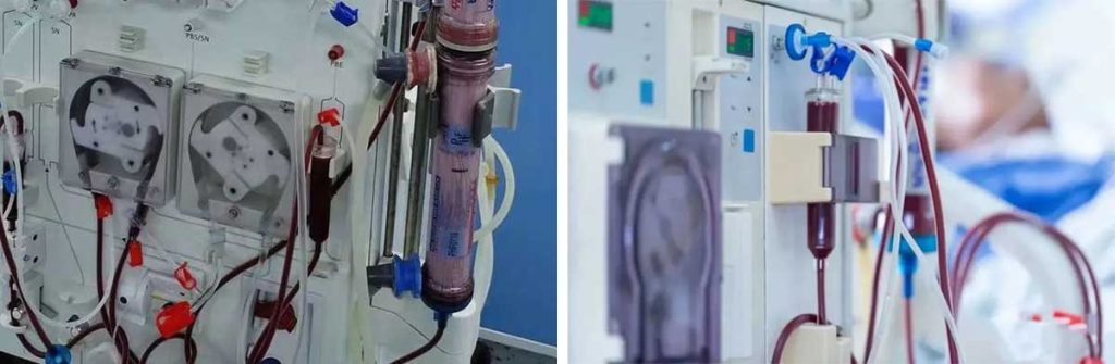 dialysis-after-heart-transplant