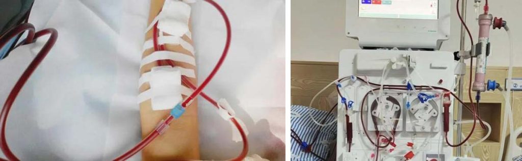 dialysis-and-blood-transfusion