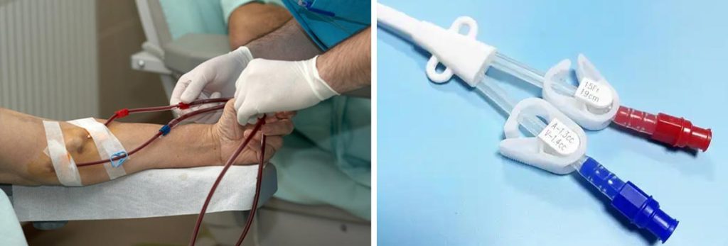 how-to-prevent-leg-cramps-after-dialysis