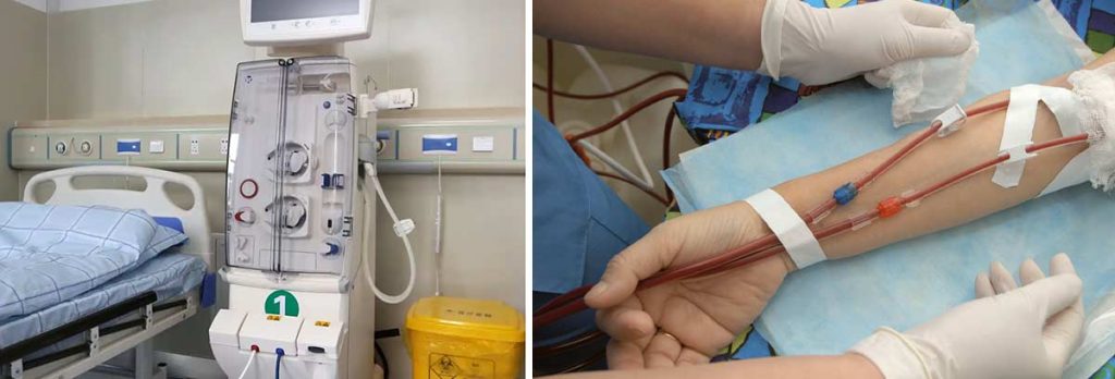 kidney-dialysis-and-oral-treatment