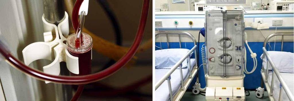 optimal-sodium-intake-for-patients-undergoing-dialysis