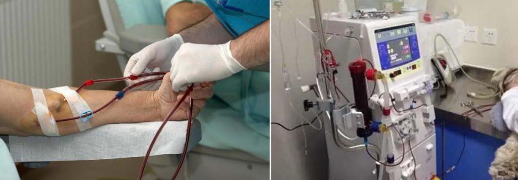 pregnant-women-on-dialysis