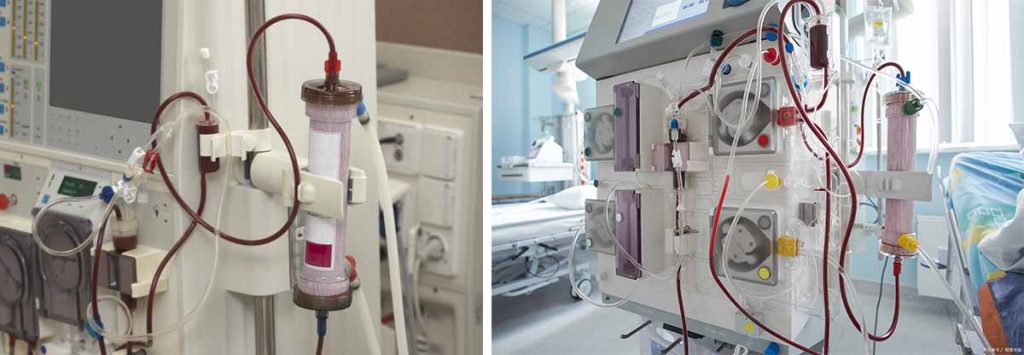 remove-lungs-fluid-by-dialysis