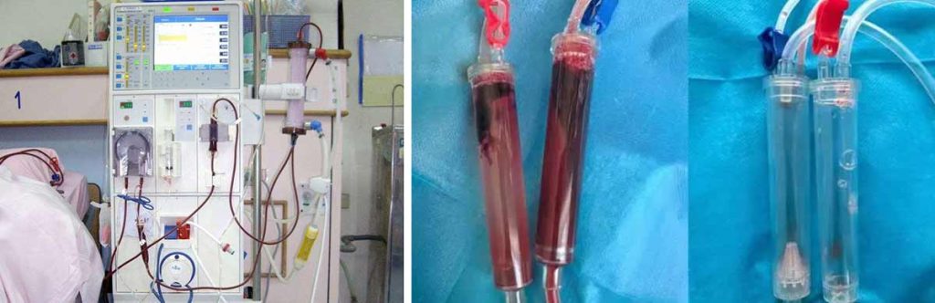 undergo-dialysis-twice-a-week