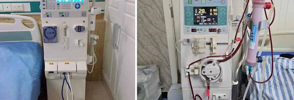 what-is-a-dialysis-shunt