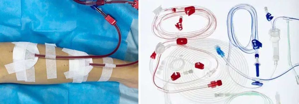 what-is-the-right-time-to-start-dialysis