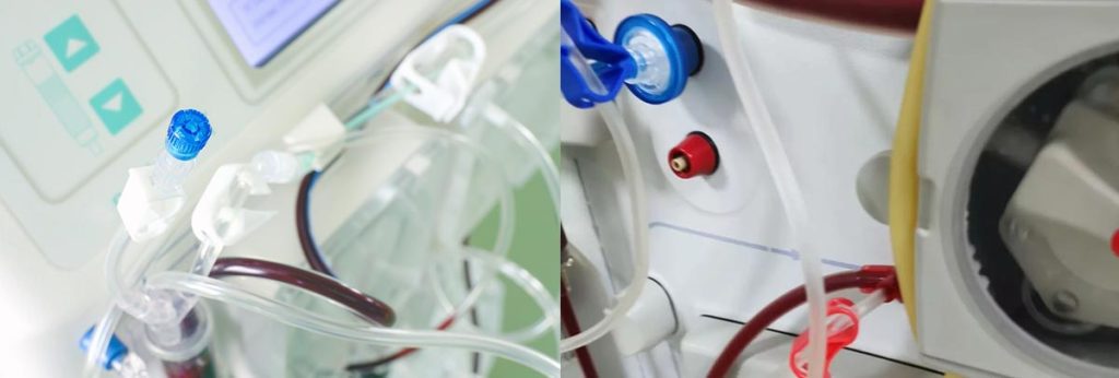 cramps-in-dialysis-patients