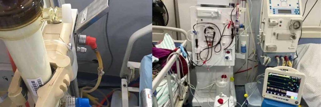 kidney-disease-and-dialysis