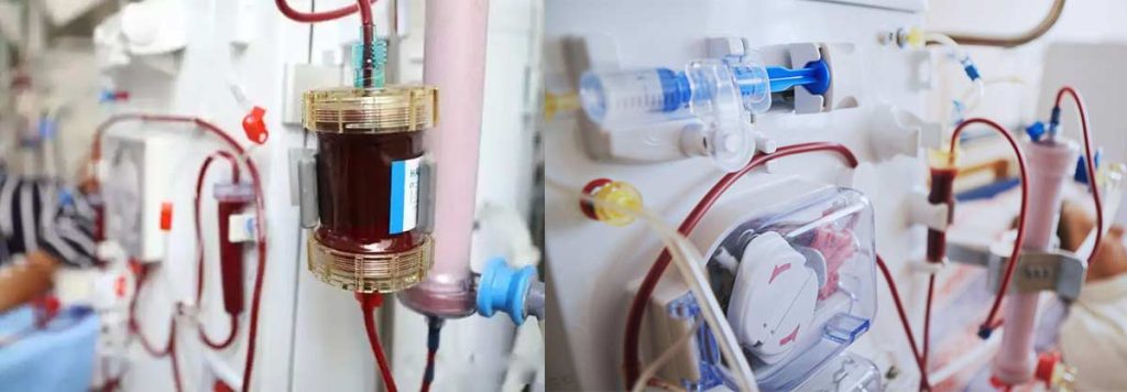 types-of-fistula-for-dialysis